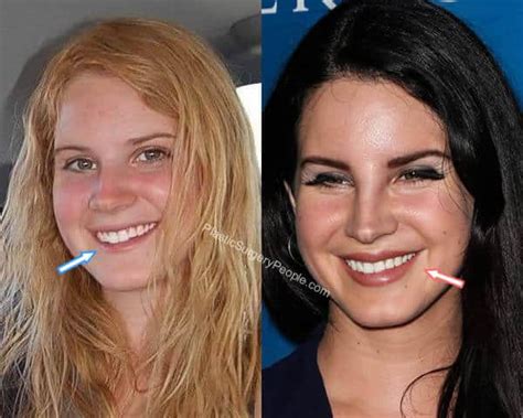 Lana Del Rey teeth